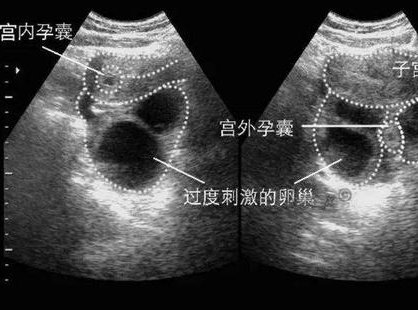 德州有没有能做二代试管婴儿的三甲公立医院？