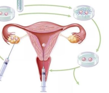 美国高龄试管婴儿费用详解