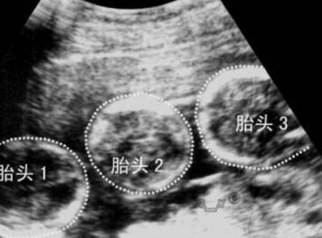 南宁哪家医院做试管婴儿成功率最高？附试管成功率费用明细！